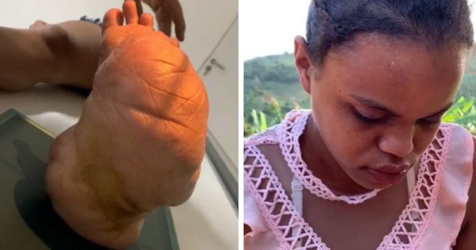 Internautas fazem surpresa acolhedora para garota que sofre bullyng por causa de tumor no pé