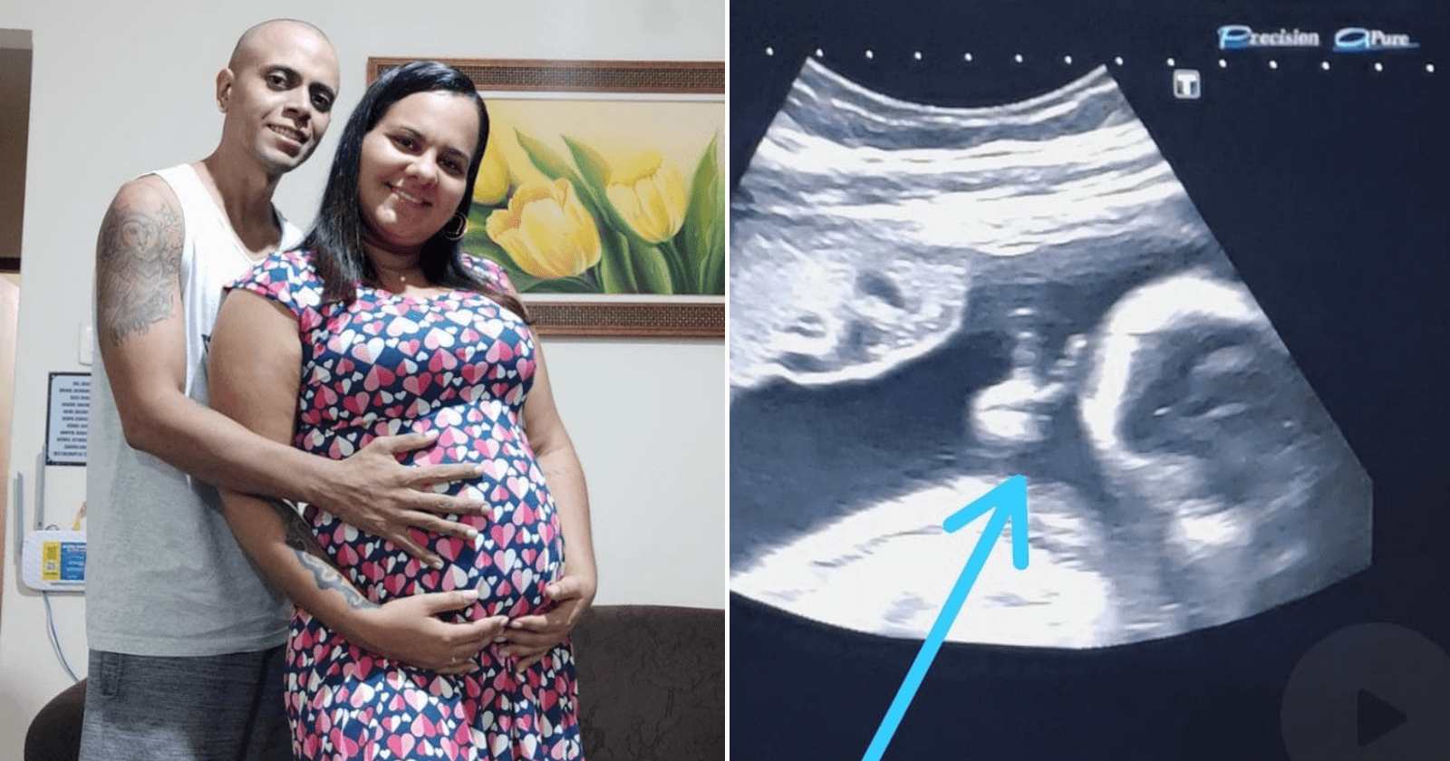Bebê faz um 'V de vitória' em ultrassom e pai com câncer afirma: 'sinal de Deus'