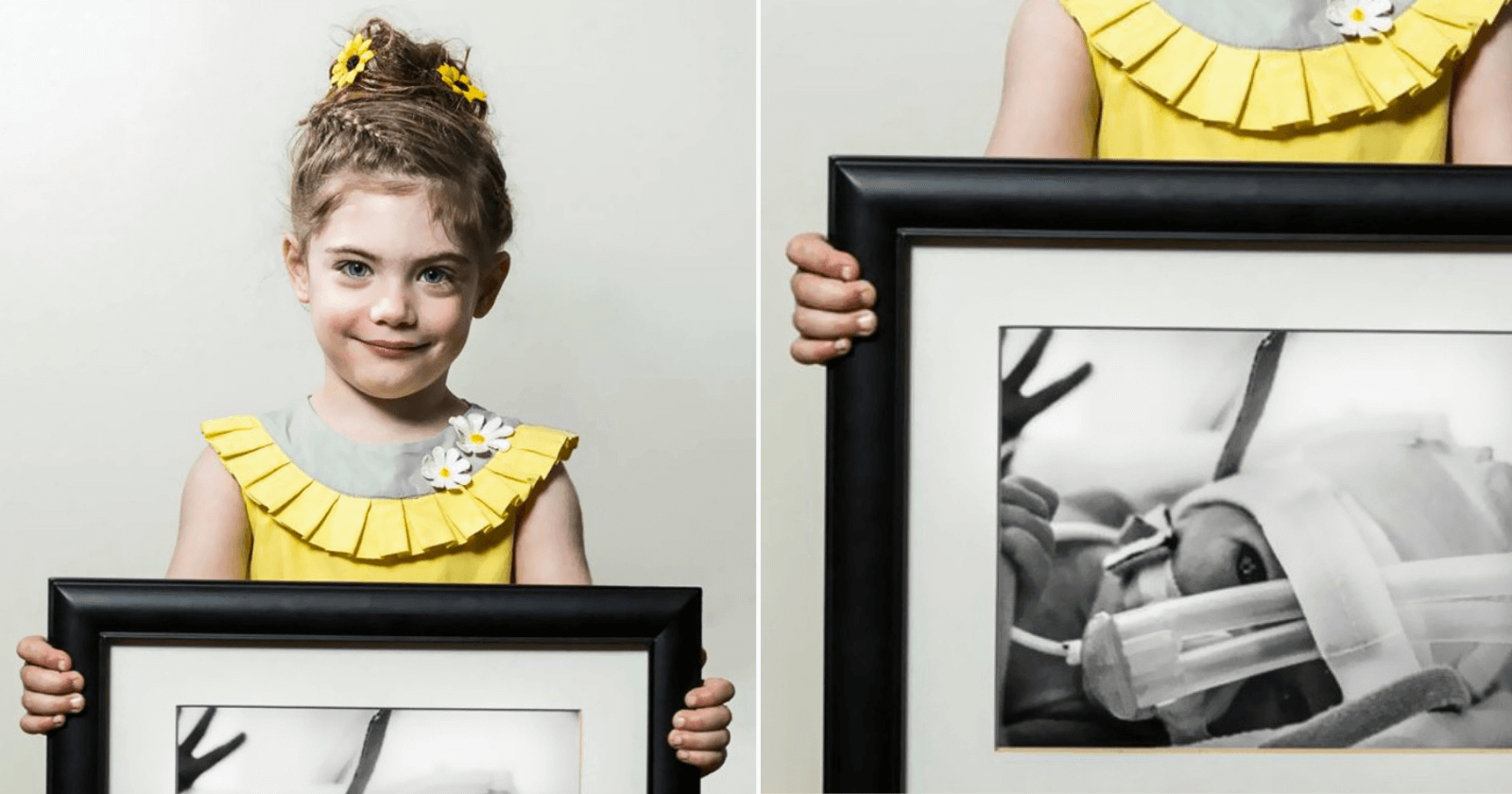 Fotógrafo mostra antes e depois de bebês prematuros e trabalho emociona fortemente