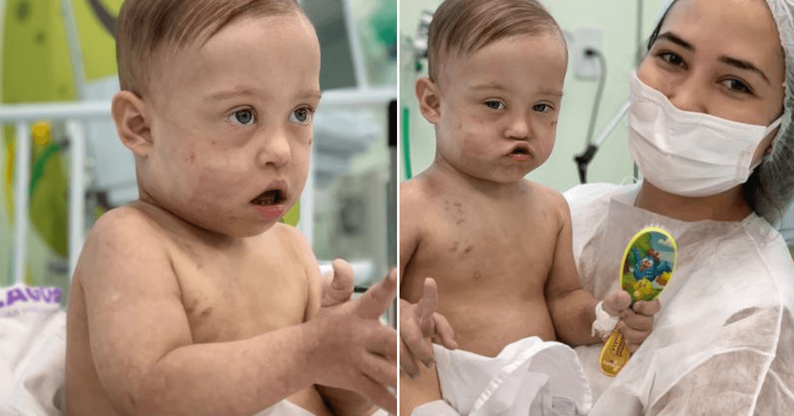 Bebê cardiopata com síndrome de Down lutando contra a leucemia vence a Covid-19