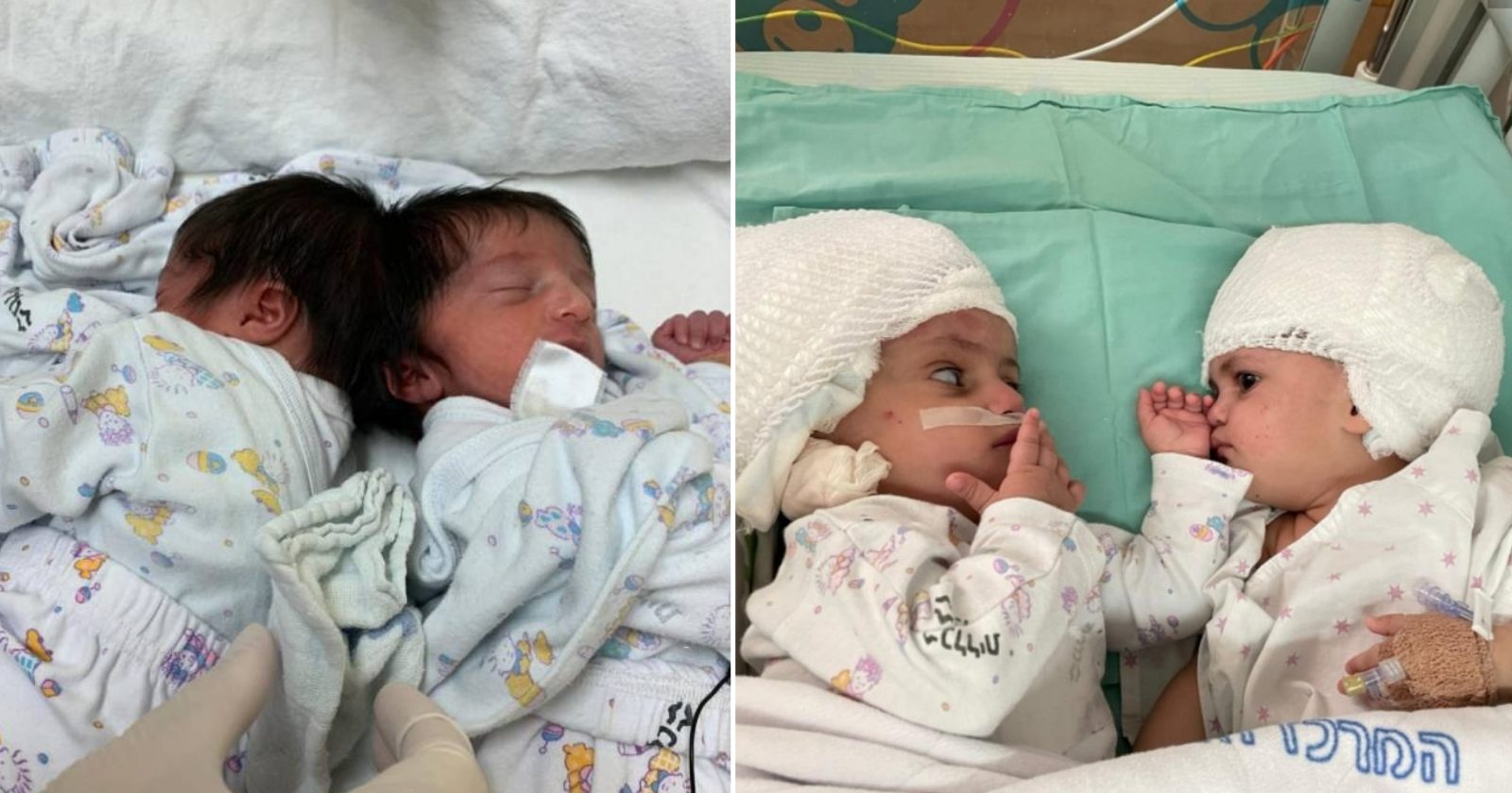 Após cirurgia de mais de 12 horas, gêmeas siamesas são separadas