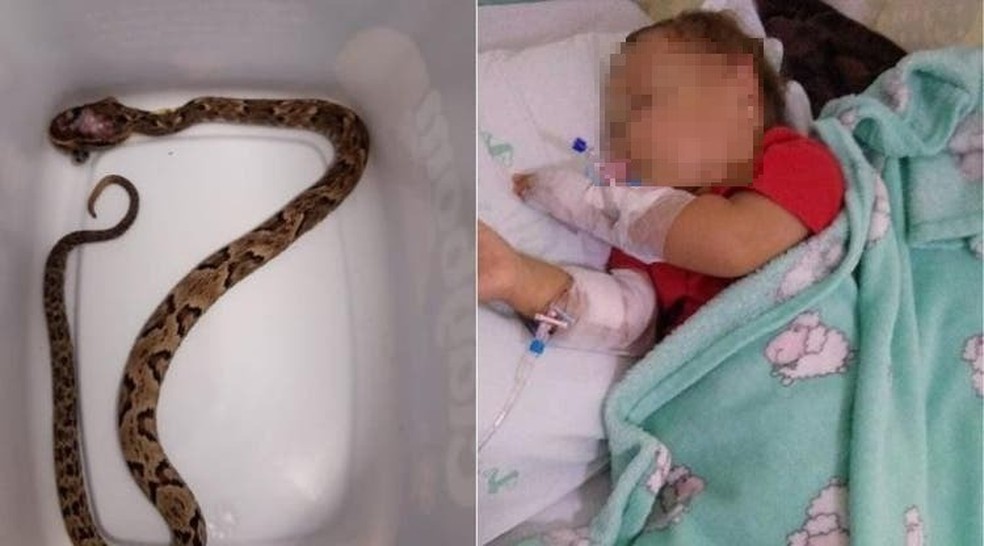 Bebê picado por cobra é salvo graças à rápida ação de médicos