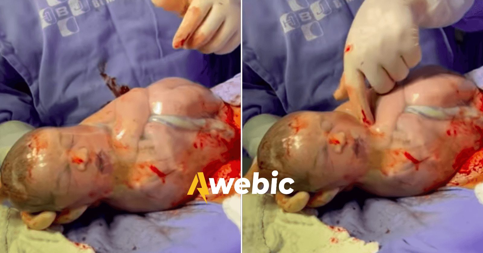 Nascimento de bebê empelicado se torna um viral emocionante