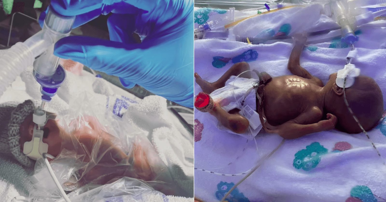 Gêmeos sobrevivem a parto prematuro de apenas 22 semanas