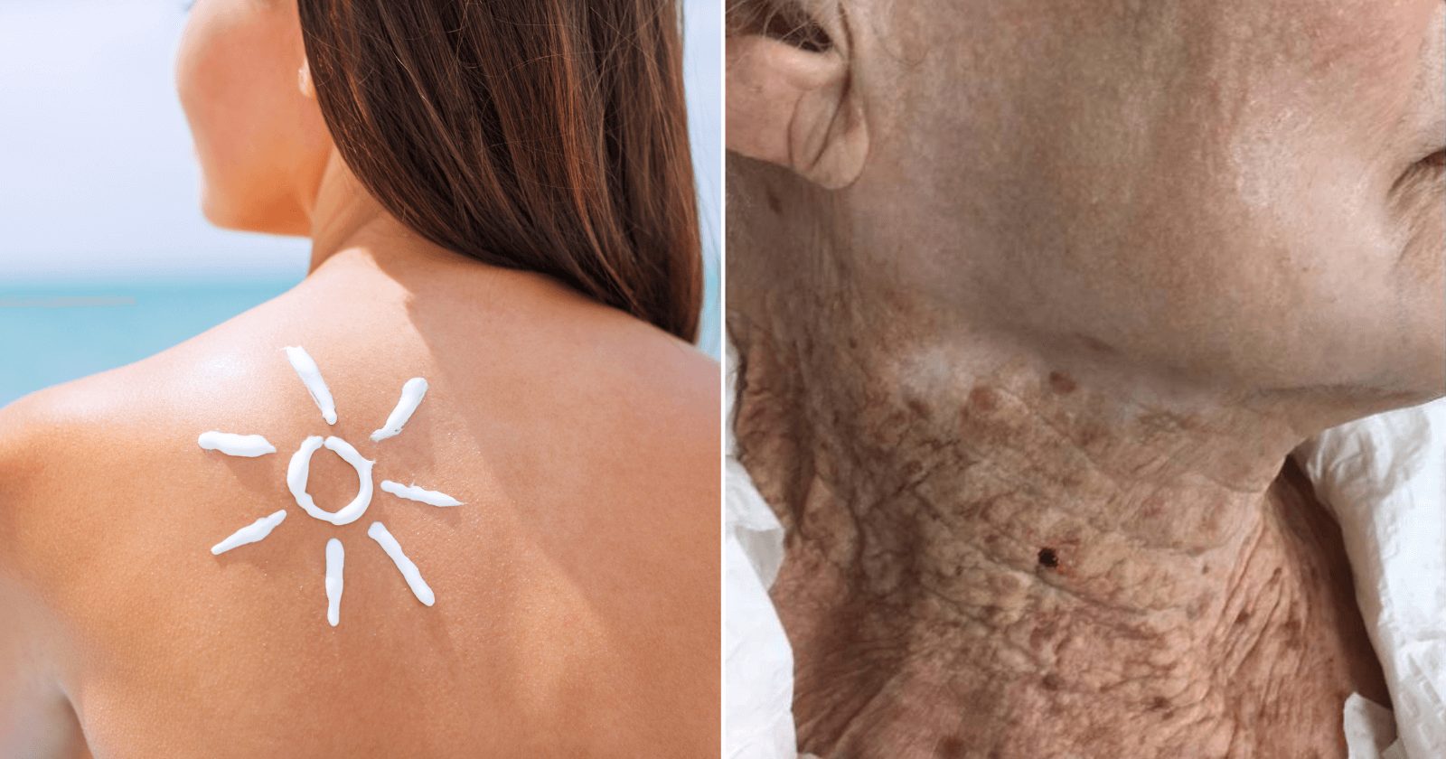 Idosa mostra diferença entre rosto e pescoço ao usar protetor solar por décadas; isso te fará ter esse hábito a partir de HOJE
