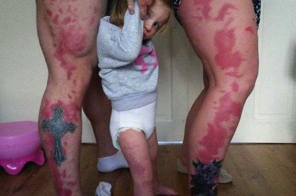 Porto seguro: Pais fazem tatuagem semelhante a marca de nascença da filha para que ela se sinta especial (Imagens: Mirror)